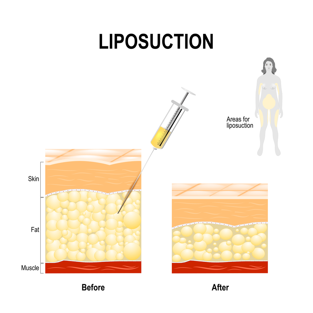 Best Liposuction Korea