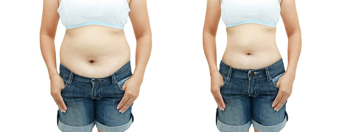 Liposuction Surgery korea before and after photo