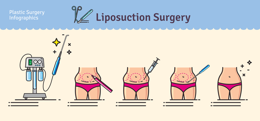 Liposuction surgery in korea
