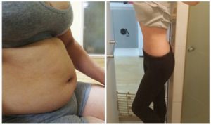 My Experience of Liposuction 1