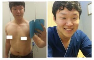 My effort to glorious journey of liposuction 