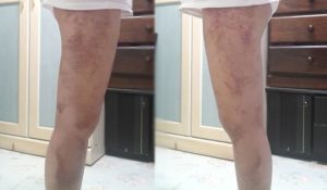 Thigh Liposuction– My journey 5