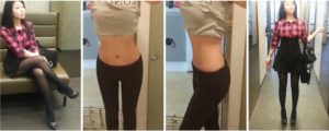 My Experience of Liposuction 6