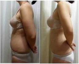 Liposuction korea Brings My Perfect Body Shape 6