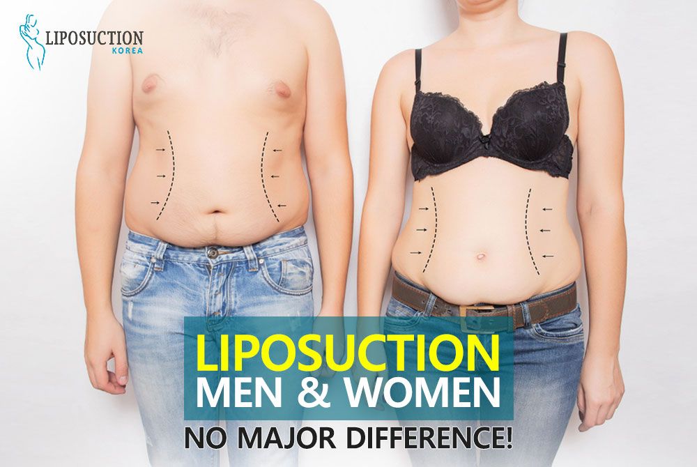 Liposuction: Men vs Women