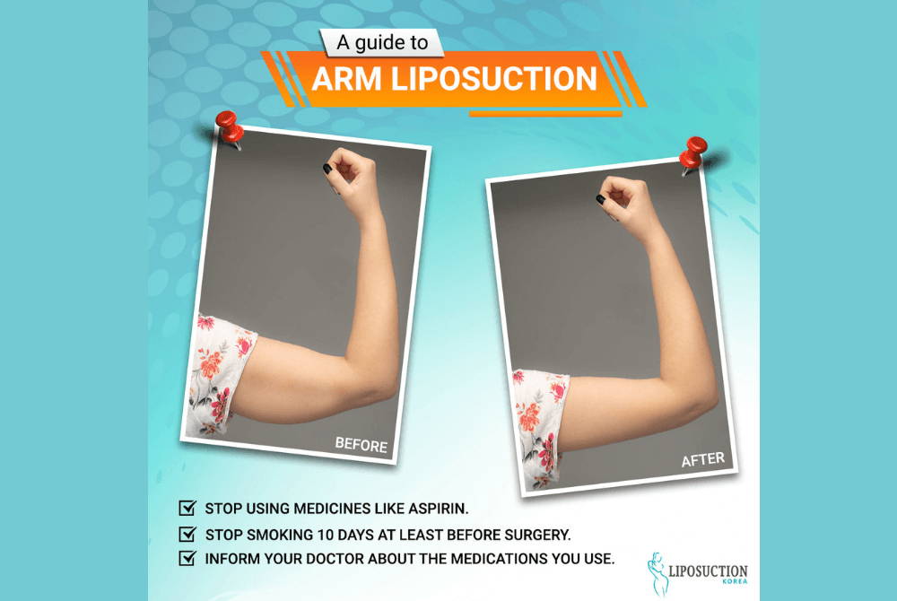 A Guide to Arm Liposuction