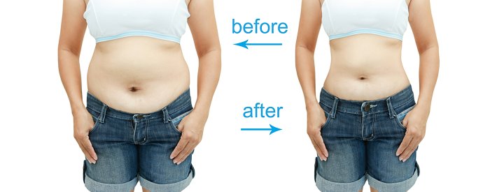 abdomen liposuction before and after images