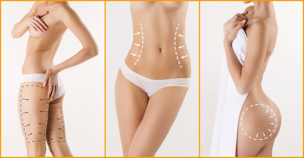 Areas that can be improved by SmartLipo are