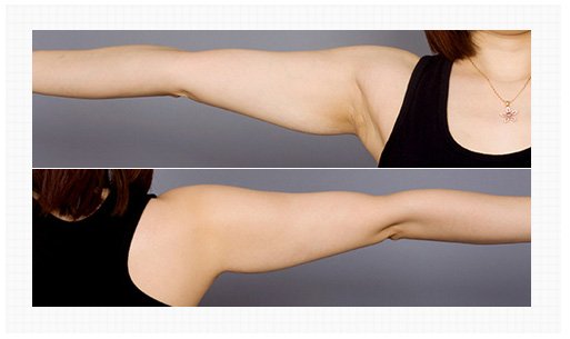 Arm liposuction Surgery Berofre and After