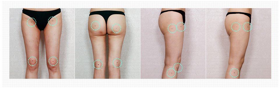 Calf Reduction Surgery Before and After images