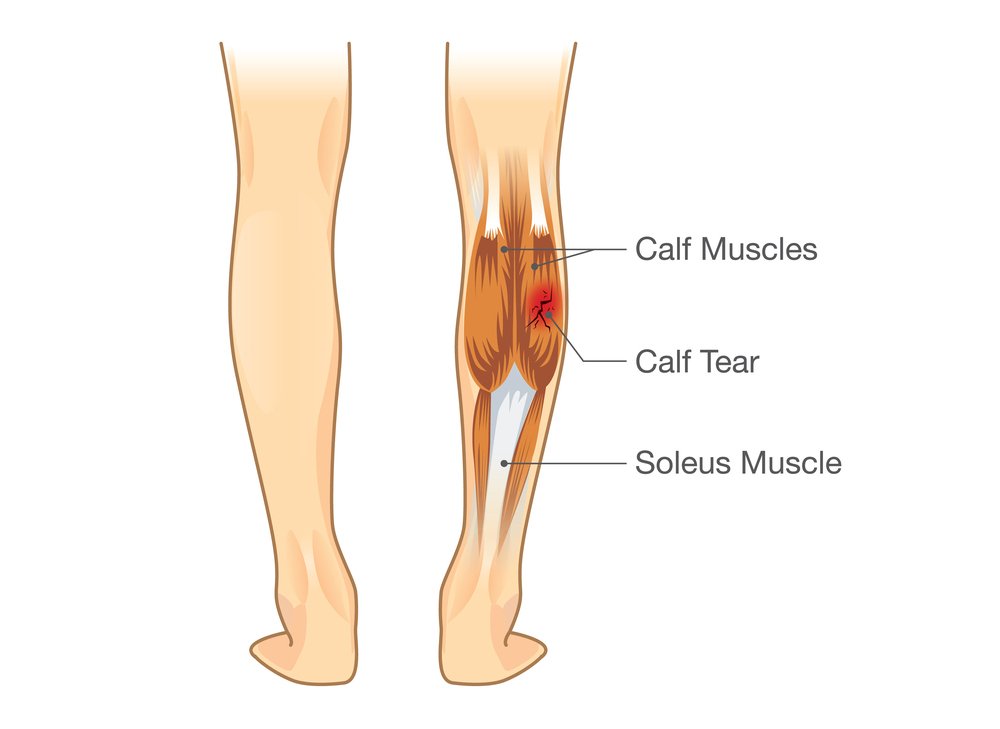 Calf reduction in Korea with Liposuction in korea