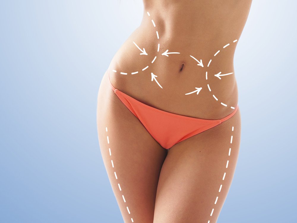 How Fat removal surgery Liposuction is performed