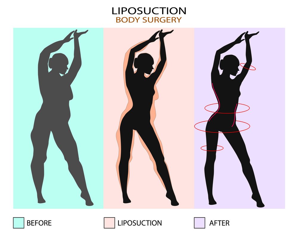 How abdomen liposuction is performed