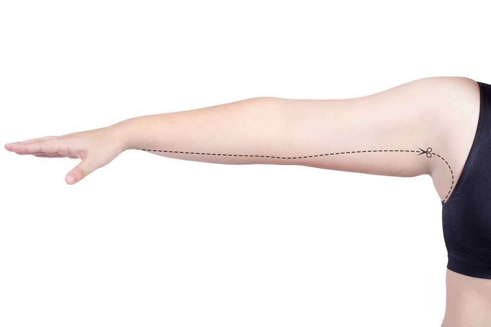 How is Arm liposuction Surgery performed