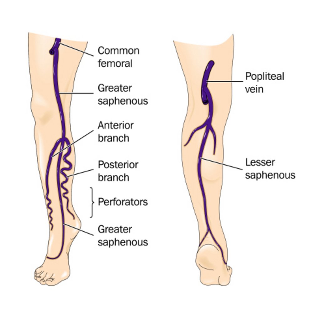 There are many factors for varicose veins laser treatment needed for expulsion and here are a few