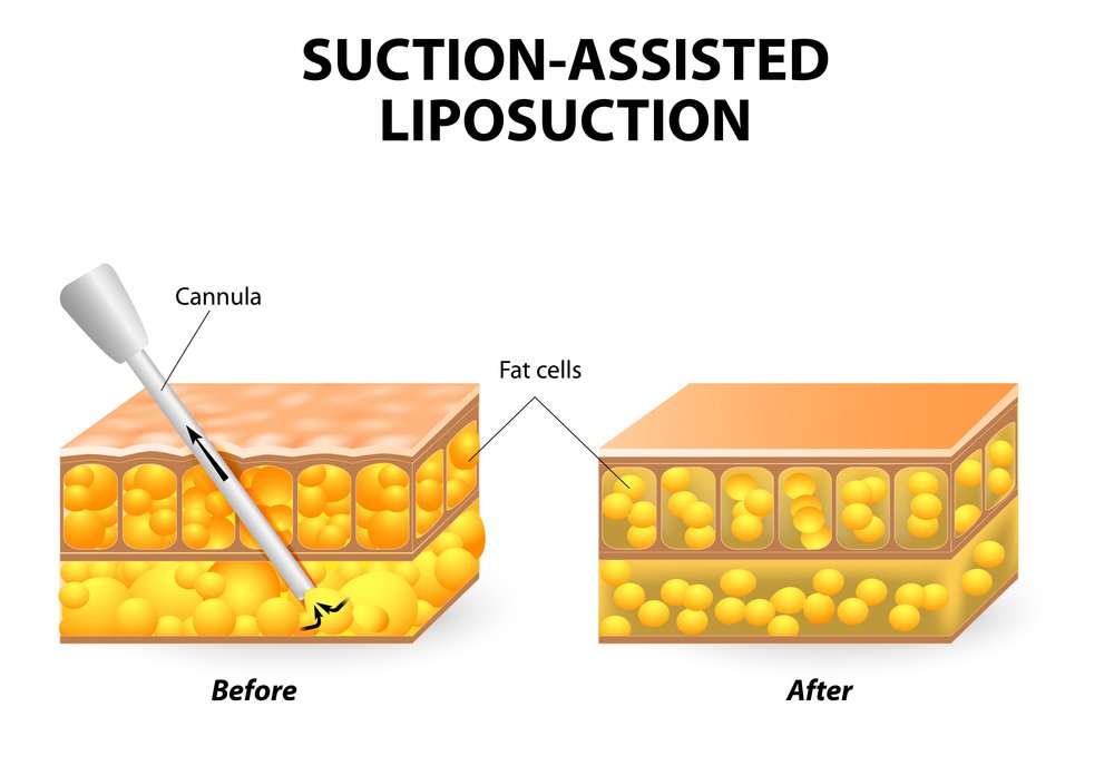 Traditional Suction Assisted Liposuction in korea