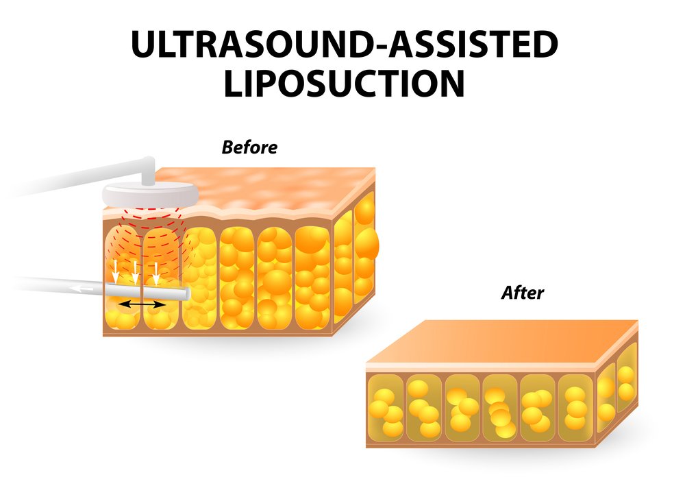 types of liposuction