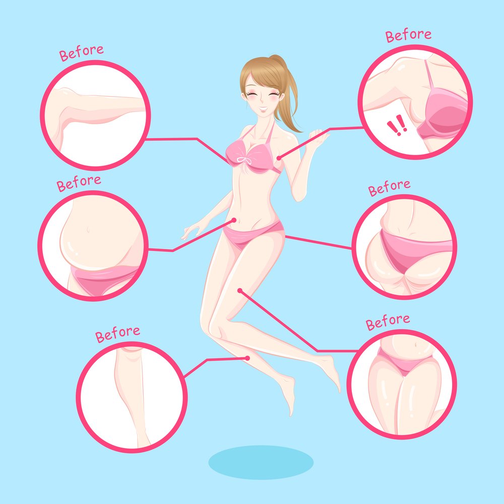 What are the ideal candidates of Liposuction