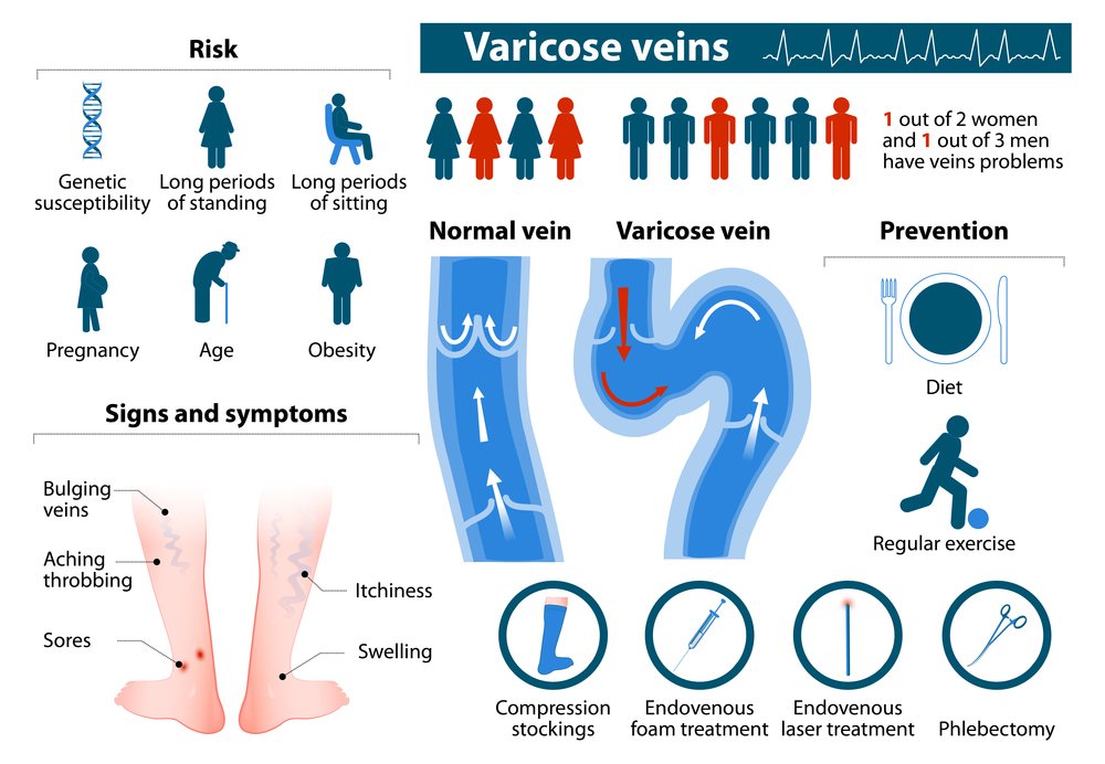 Varicose Veins Treatment Korea, Laser Varicose Veins Removal in Seoul South  Korea