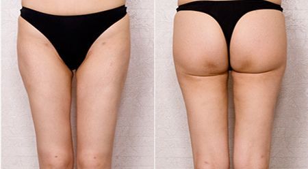 Thigh Liposuction korea 2