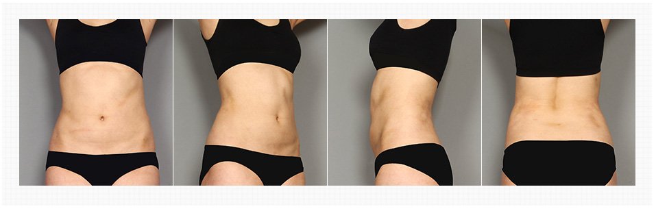 Tummy Tuck in Korea Before and After