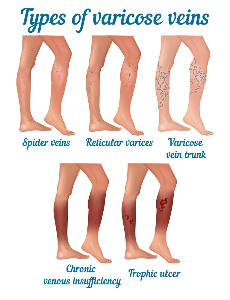 Spider Veins Vs Varicose Veins Treatment: What's the Difference