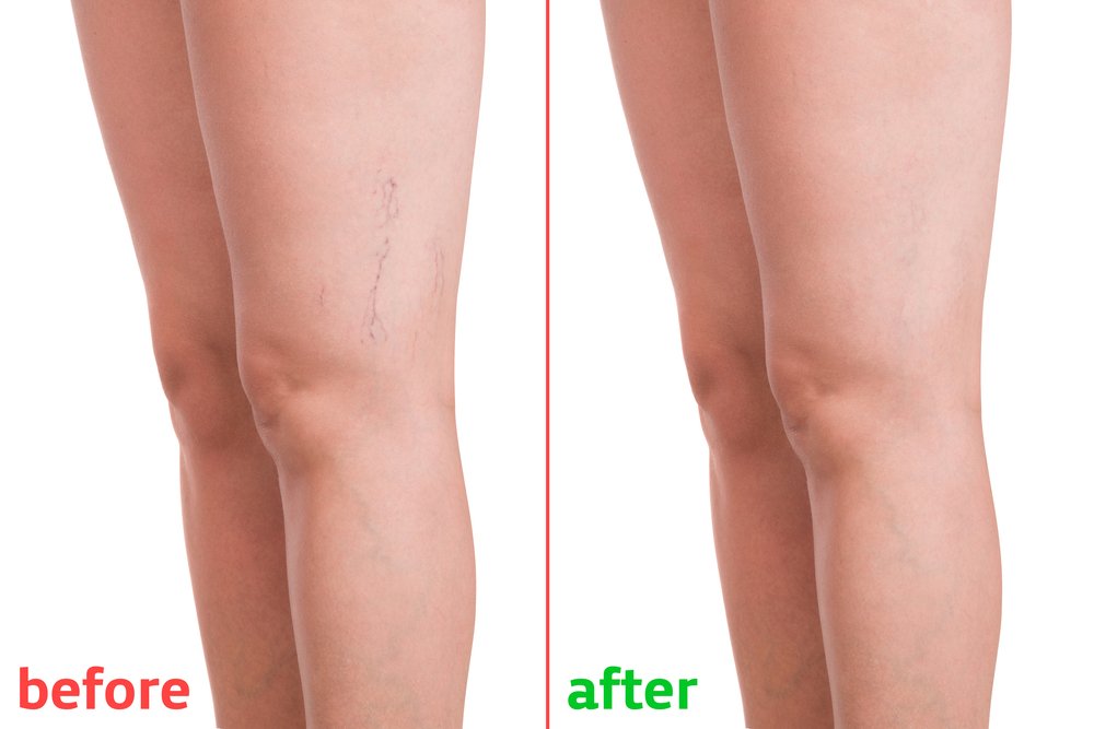 Varicose Veins before and after