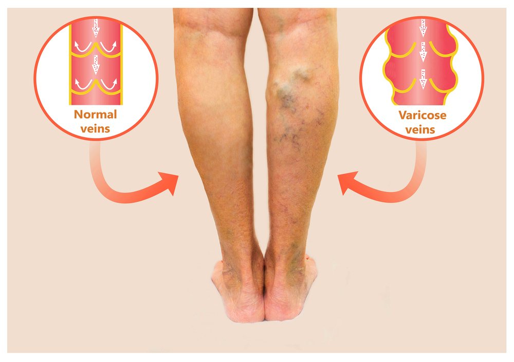 How Do You Treat Varicose Veins In The Stomach