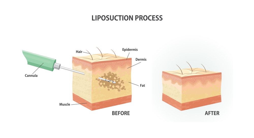 liposuction cost in Korea