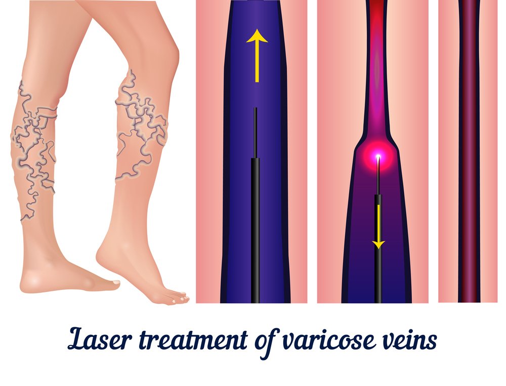 varicose veins laser treatment