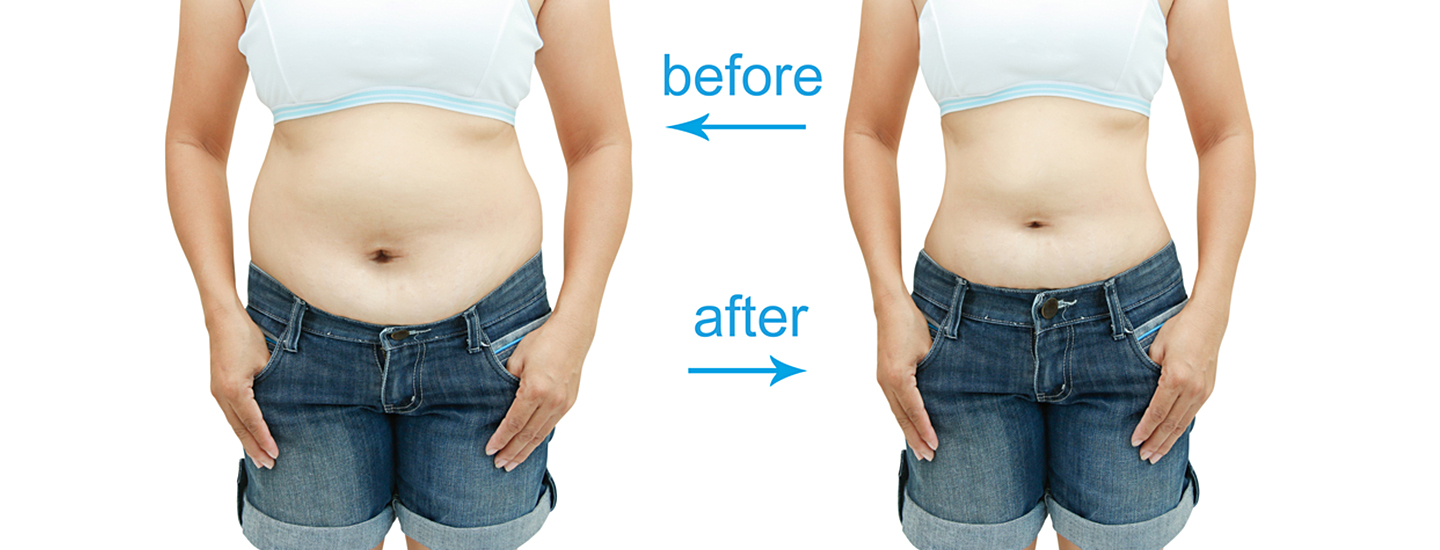 Liposuction before and after