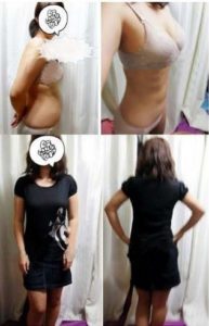 Liposuction korea Brings My Perfect Body Shape 7
