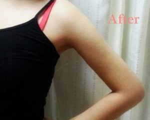 My forearm liposuction before and after 7