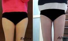 Thigh Liposuction– My journey